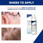 Keralyt 5 Anti-Dandruff Shampoo - Max Strength 5% Salicylic Acid Scalp Build-Up Clearing - Promotes Relief from Dandruff, Psoriasis, Seborrheic Dermatitis, Dryness, and Itchiness, 177 milliliters - Image 4