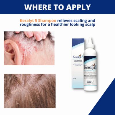 Keralyt 5 Anti-Dandruff Shampoo - Max Strength 5% Salicylic Acid Scalp Build-Up Clearing - Promotes Relief from Dandruff, Psoriasis, Seborrheic Dermatitis, Dryness, and Itchiness, 177 milliliters - Image 4